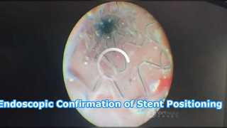Endoscopic Confirmation of Stent Positioning
