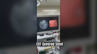 New Progress | EVT Covered Stent Used in First Complex Ureteral Surgery at Chang'an Hospital