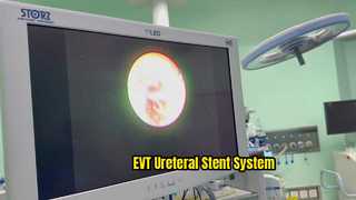 EVT Ureteral Stent System