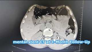 CT at 1-Month Follow-Up
