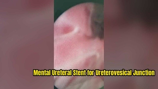 Mental Ureteral Stent for Ureterovesical Junction Stricture