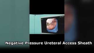 The Flexible Negative Pressure Sheath — The Ureteroscope’s “Perfect Duo”